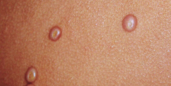 Molluscum Contagiosum (vodene ospice): Simptomi, Uzroci, Liječenje i Prevencija