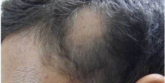 Alopecija Areata: simptomi, uzrok, komplikacije, prevencija i mogućnosti liječenja