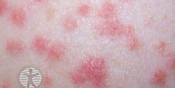 Simptomi Psorijaze: kako ih prepoznati