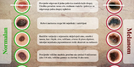 Kako prepoznati rak kože