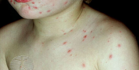 Simptomi Vodenih Kozica Po Danima: Kako Prepoznati Razvoj Infekcije